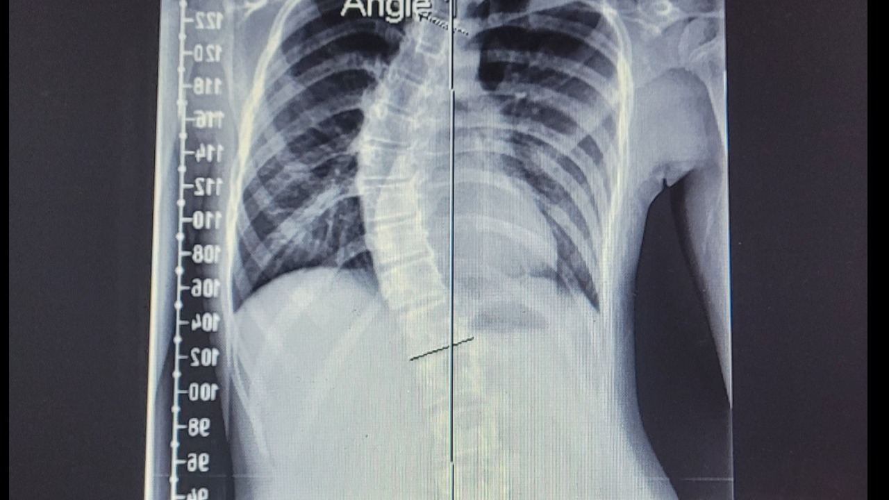 Scoliosis Surgery for Daughter